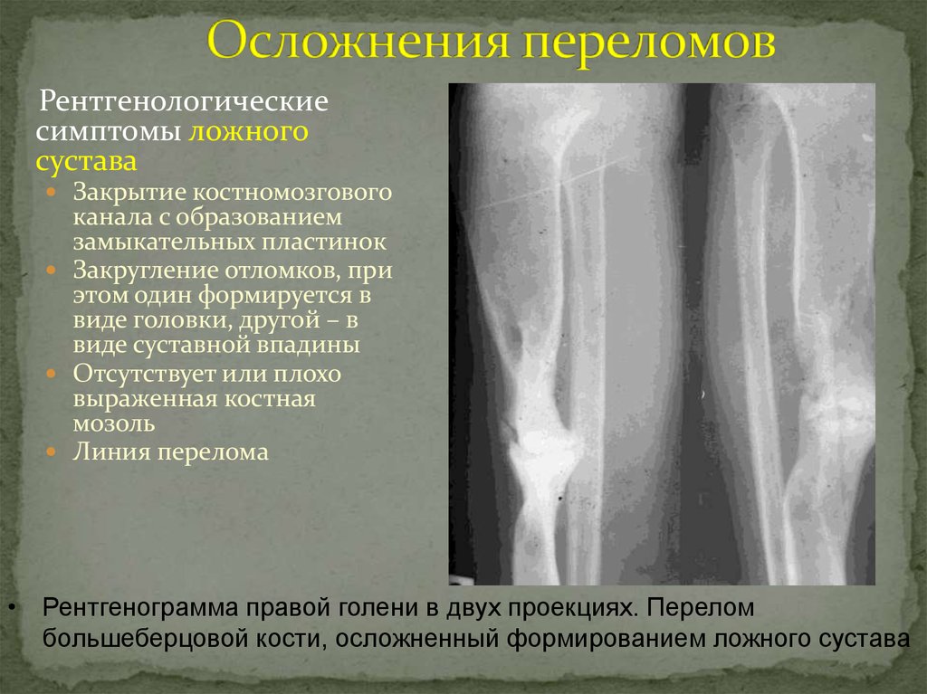 Трещина это перелом. Ложный сустав плечевой кости рентген. Рентгенологический диагноз ложного сустава. Ложный сустав берцовой кости. Ложный сустав рентген признаки.