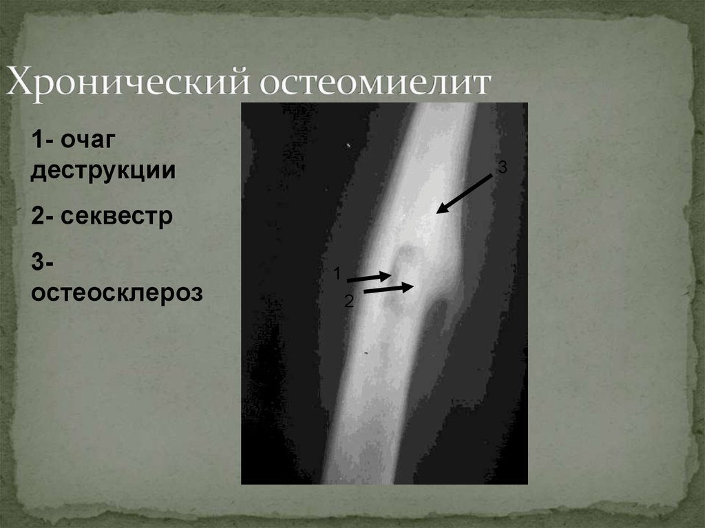 Огнестрельный остеомиелит. Хронический остеомиелит.