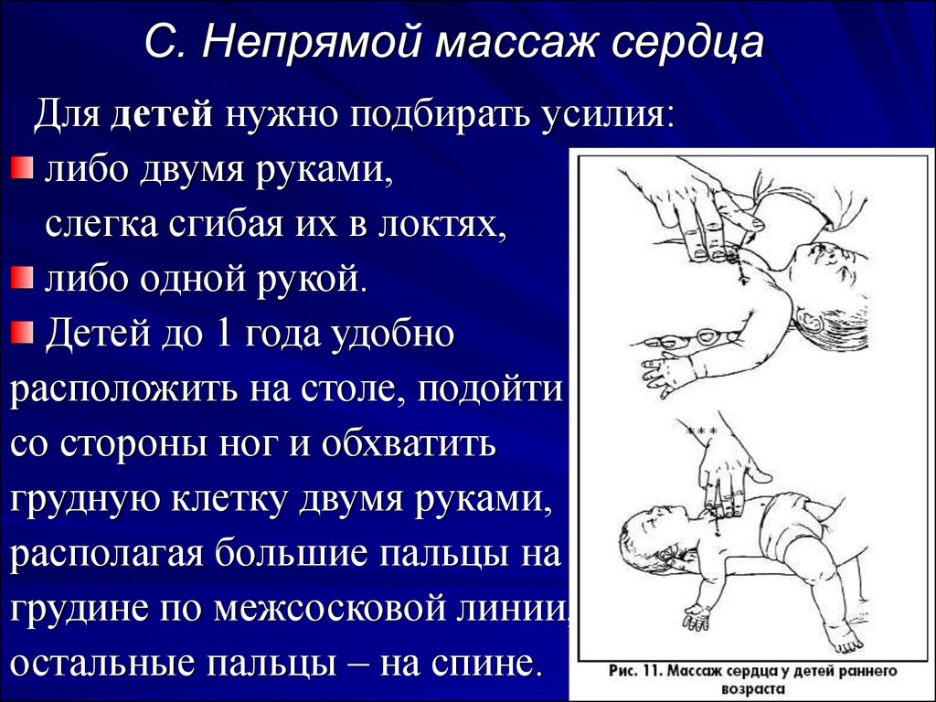 Надавливание при непрямом массаже сердца. Алгоритм проведения наружного непрямого массажа сердца. Непрямой массажсредца. Нне прямой массаж сердца. Непрямой массаж сердца выполняется.