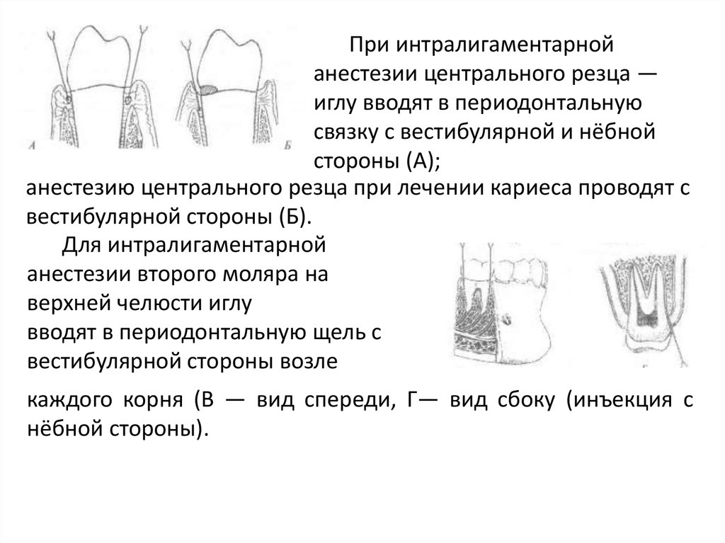 Интрасептальная анестезия