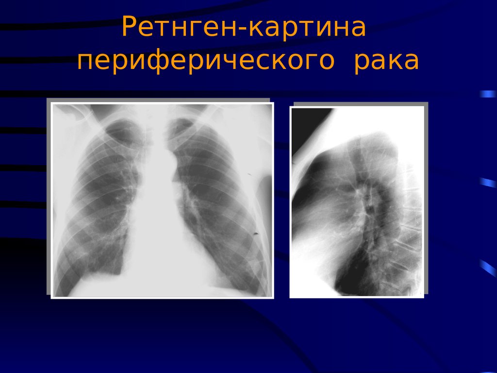 Рак нижней доли. Периферическая опухоль с централизацией. Как выглядит онкология в лёгких. Картина периферического TRC 8. Спавшиеся лёгкое ретнген.