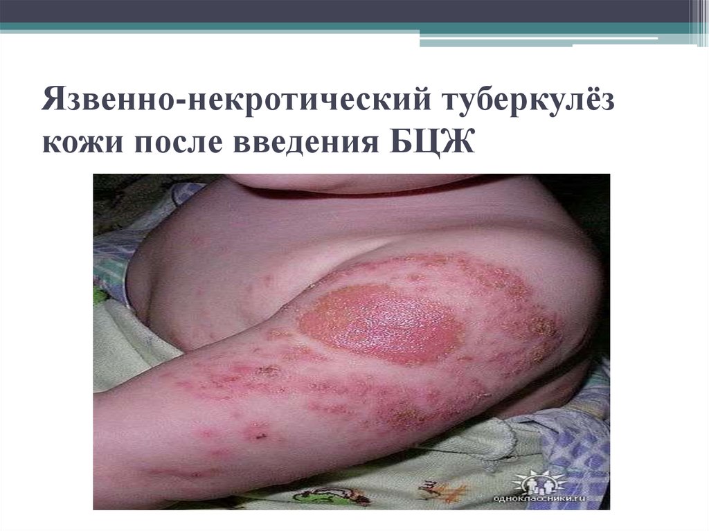 Язвенно-некротический туберкулёз кожи после введения БЦЖ