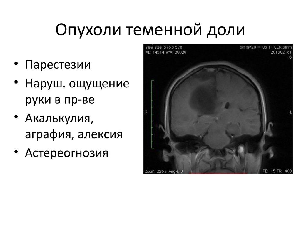 Нейроонкология