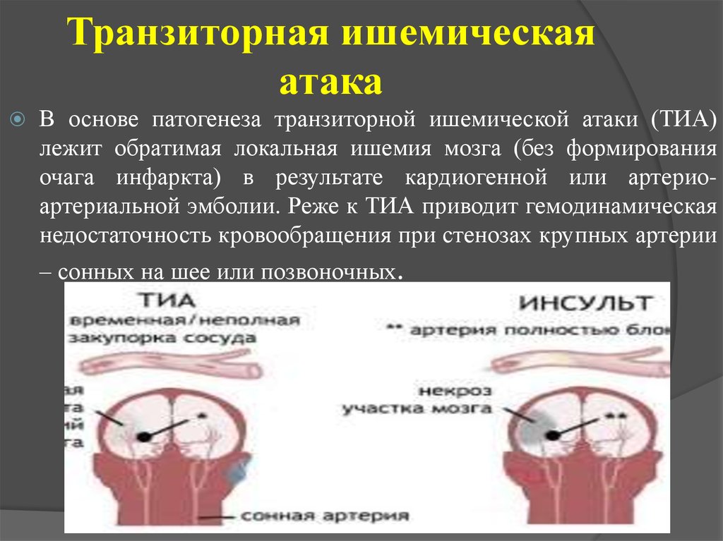 Ишемическая атака мозга симптомы и последствия