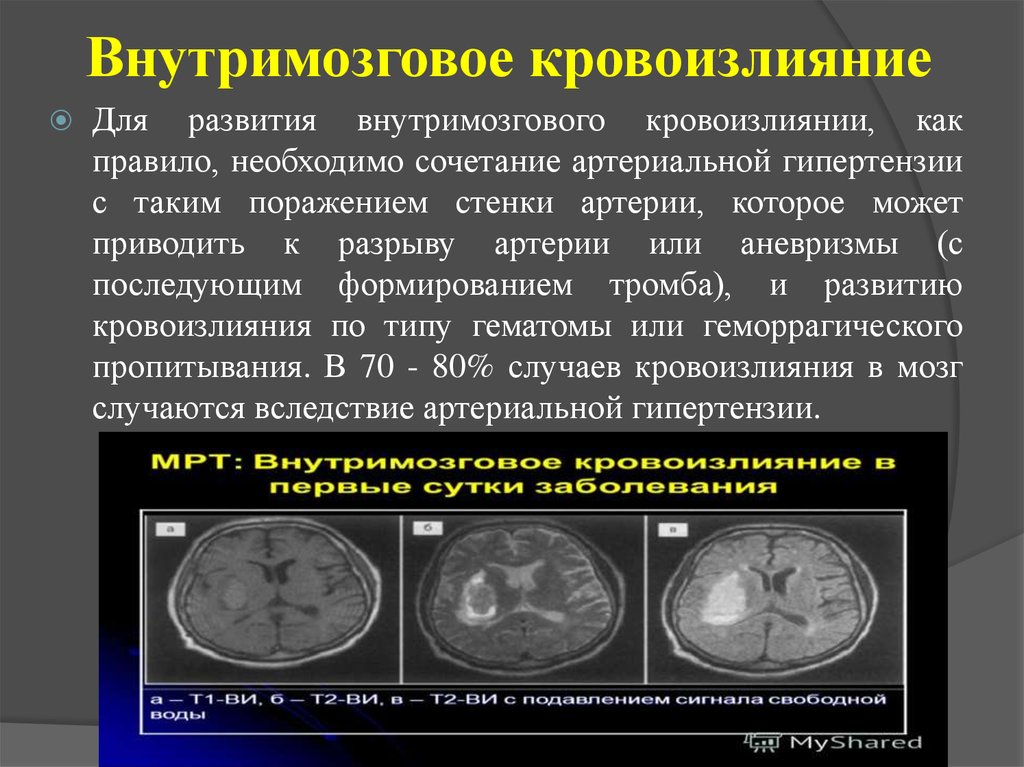 Кровоизлияние в полушарие. Внутримозговое кровоизлияние. Геморрагический инсульт внутримозговое кровоизлияние. Внутримозговое (паренхиматозное) кровоизлияние. Внутримозговое кровоизлияние в полушарие субкортикальное.