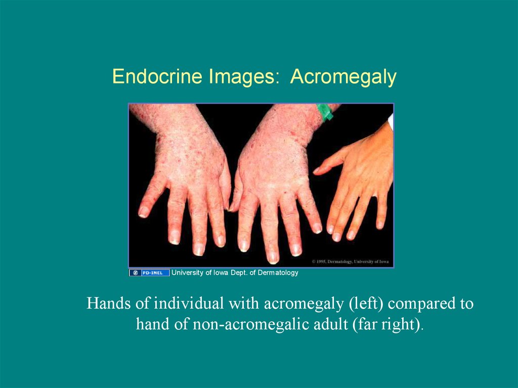 Acromegaly. Description - презентация онлайн