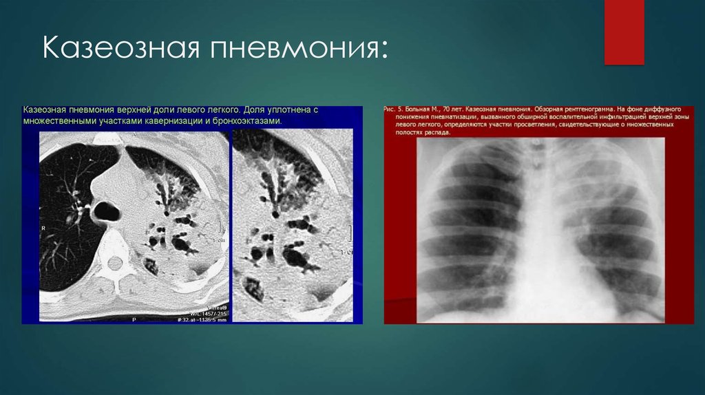 Казеозная пневмония схема