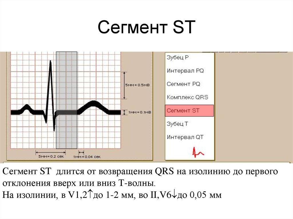 St на экг. Сегмент ст на ЭКГ. Сегмент St на ЭКГ на изолинии. Сегмент St на ЭКГ В норме. Отклонение сегмента St на ЭКГ.