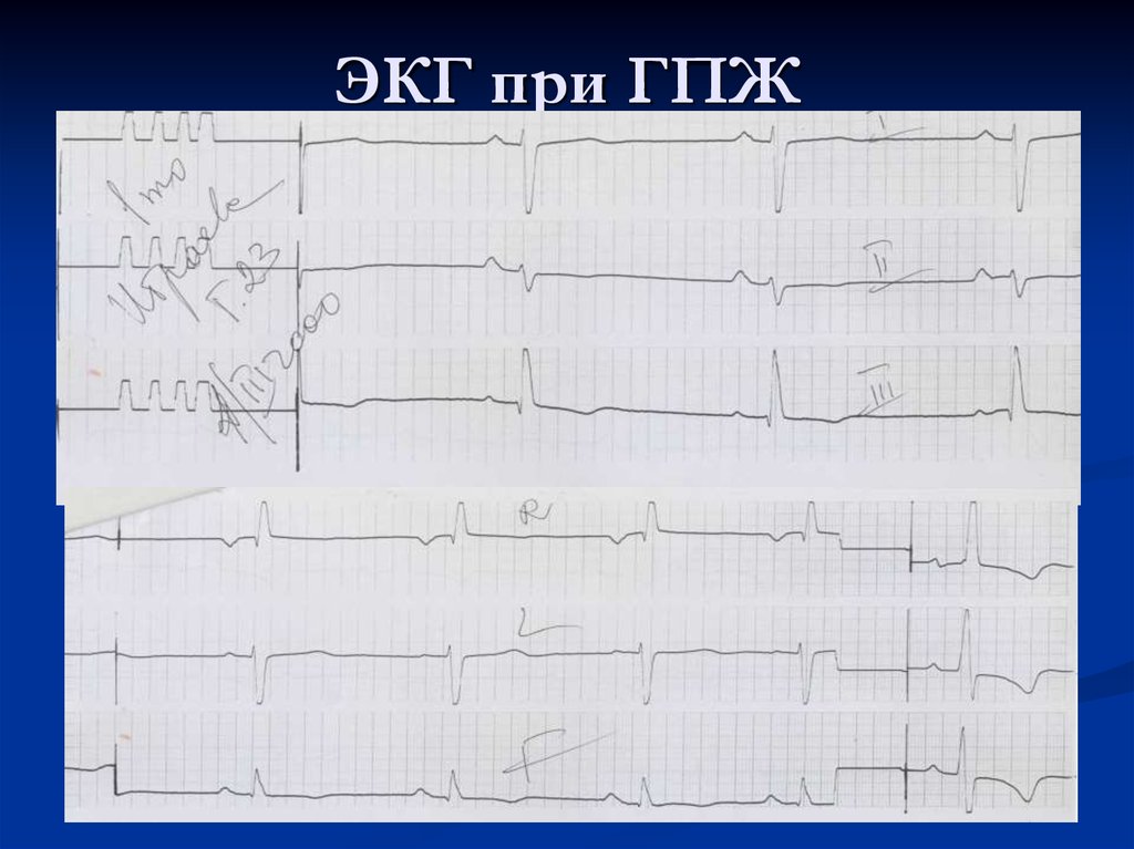 Чсс по экг 25 мм. Гипертрофия правого желудочка на ЭКГ. Электрофизиологические основы ЭКГ. ГПЖ на ЭКГ. Гипертрофия пж.