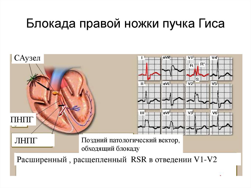 Неполная блокада правой ножки пучка гиса что. Неполная блокада правой ножки пучка на ЭКГ. Блокада правого пучка Гиса на ЭКГ. ЭКГ блокада правой ножки п.Гиса. Блокада правой ножек пучка Гиса на ЭКГ.