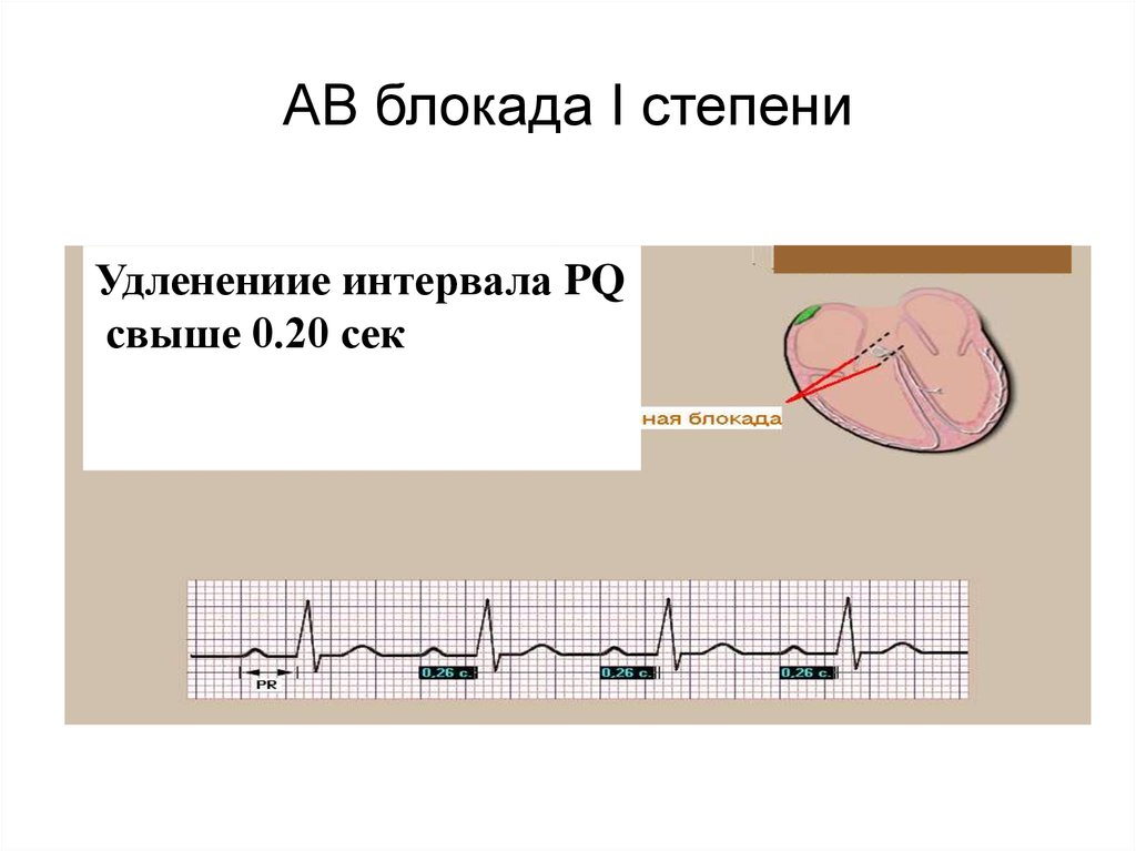 Блокада первой степени. АВ блокада 1 степени. Av блокада 1 степени. АВ блокада интервал PQ. Блокада 1 й степени.