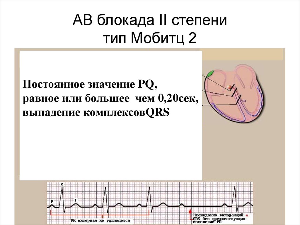 Выпадение комплекса. Av блокада 2 степени Мобиц 2. АВ-блокада 2 степени, Тип Мобитц 1 на ЭКГ. АВ блокады 2 степени Мобиц 2 на ЭКГ. ЭКГ критерии АВ блокады 2 степени Мобитц 2.