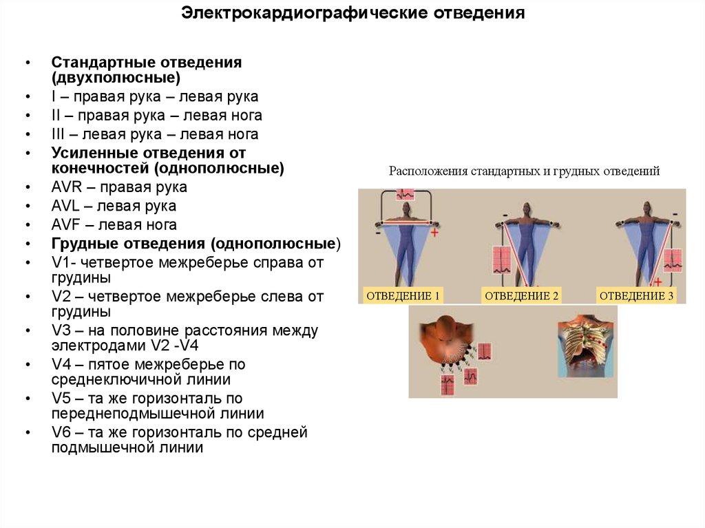 Стандартные отведения экг схема наложения электродов