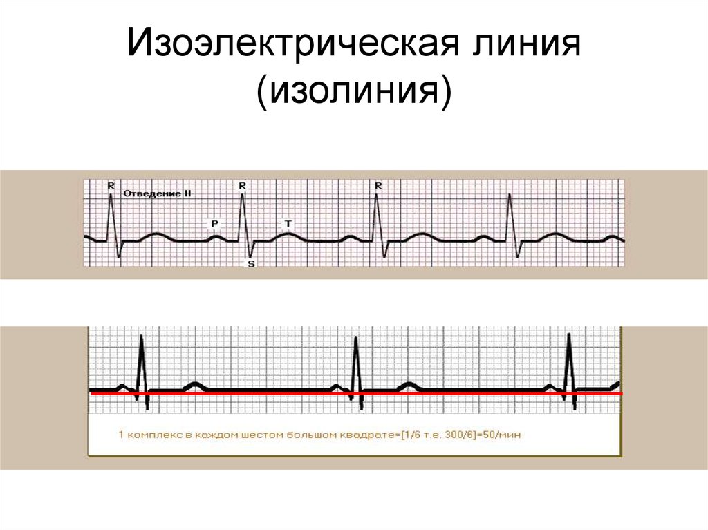 Экг где. Изоэлектрическая линия на ЭКГ это. Изолиния на ЭКГ. Как определить изолинию на ЭКГ. Понятие об изоэлектрической линии ЭКГ.