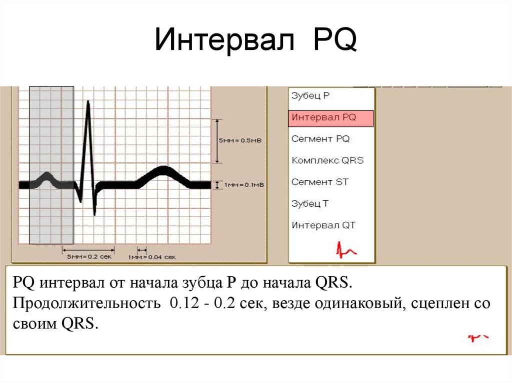 Р q. Интервал PQ на ЭКГ. Удлинение интервала PQ на ЭКГ. Интервал PQ на ЭКГ норма. QRS интервал PQ.