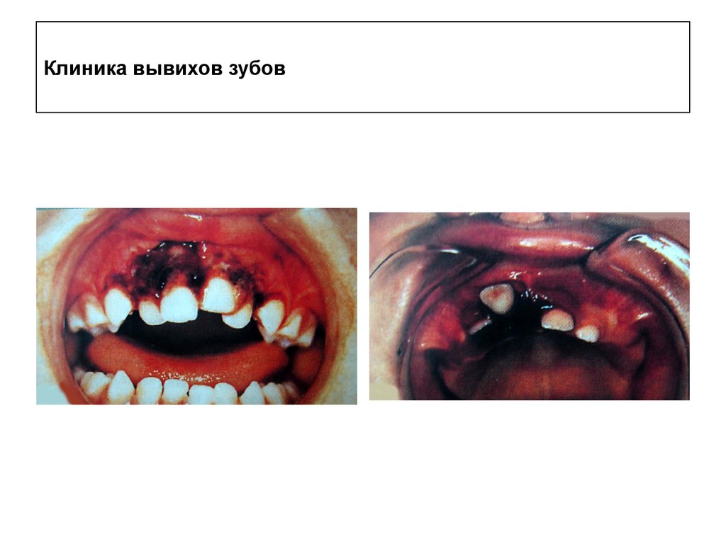 Клиника вывихов зубов