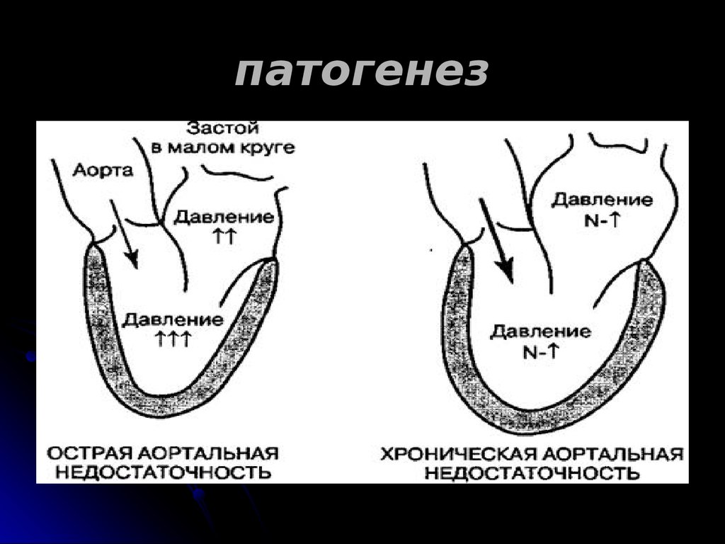 Аортальная недостаточность презентация