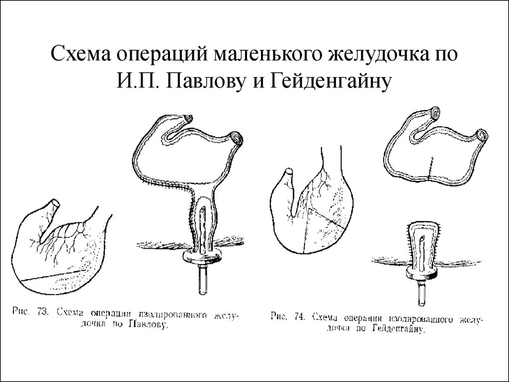 Маленький желудок. Операция малый желудок Павлова. Схема операции изолированного желудочка по Гейденгайну. Изолированный желудочек по Гейденгайну. Схема операции изолированного желудочка по Гейденгайну и по Павлову.