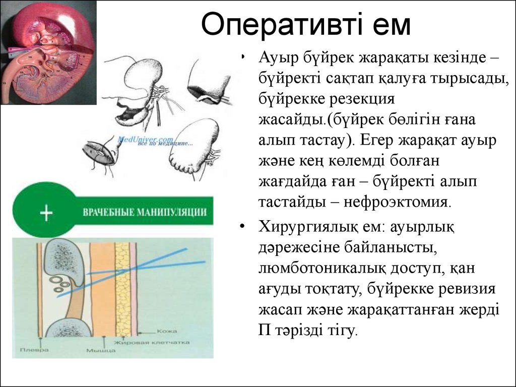 Нефроэктомия