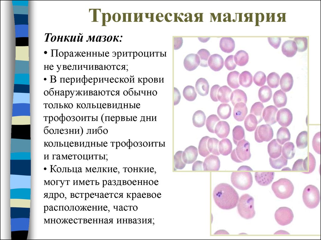 Кровь на малярию. Тонкий мазок крови при малярии. Тропическая малярия лабораторная диагностика. Эритроциты трехдневная малярия. Мазок крови больного трёхдневной малярией.