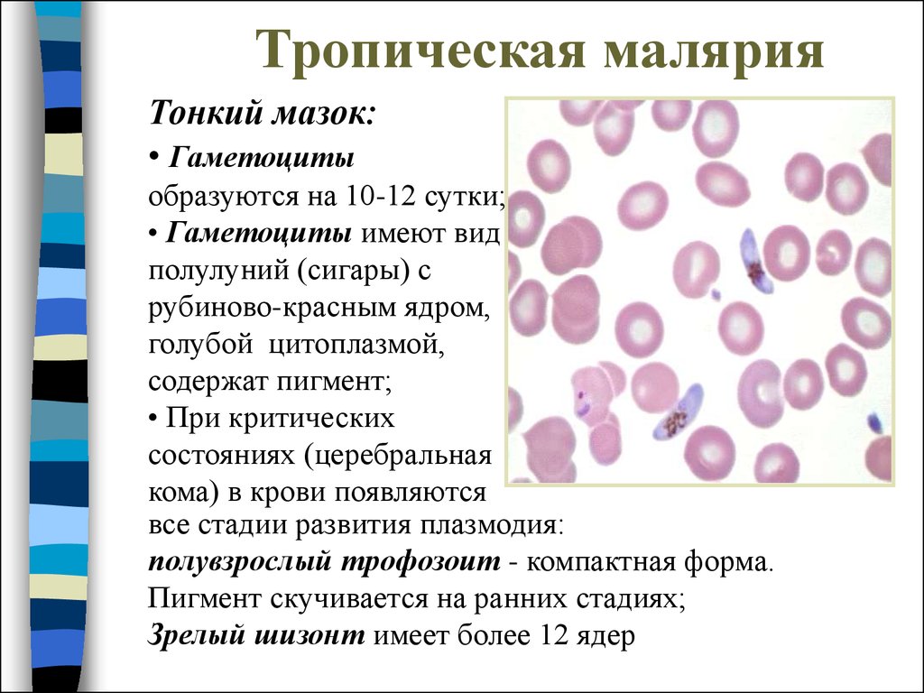Неблагоприятный лабораторный признак при тропической малярии. Мазок крови больного малярией гаметоцит. Тропическая малярия мазок крови. Малярия микроскопия тонкий мазок. Мазок крови больного трёхдневной малярией.