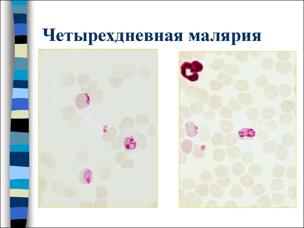 Кровь на малярию. Трехдневная малярия мазок крови. Трехдневная малярия лабораторная диагностика. Малярия овале лабораторная диагностика. Малярия в тонком мазке.
