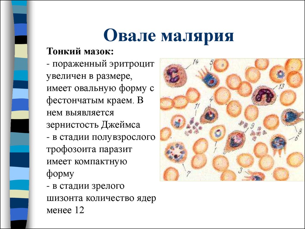 Изменения свойств эритроцитов при тропической малярии проявляются. Малярия в тонком мазке. Малярия овале лабораторная диагностика. Малярия микроскопия тонкий мазок. Тонкий мазок крови при малярии.