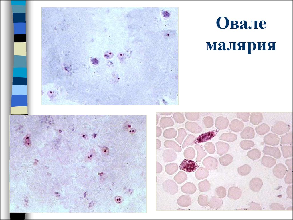 Кровь на малярию. Малярия овале лабораторная диагностика. Малярия овале возбудитель.