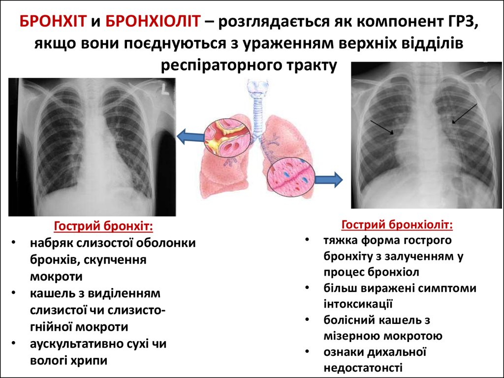 Легкие без температуры. Хрипы в легких при бронхите. Хрипы при бронхите у ребенка. Хрипы в лёгких при бронхите. Хрипы в лёгких у ребенка.