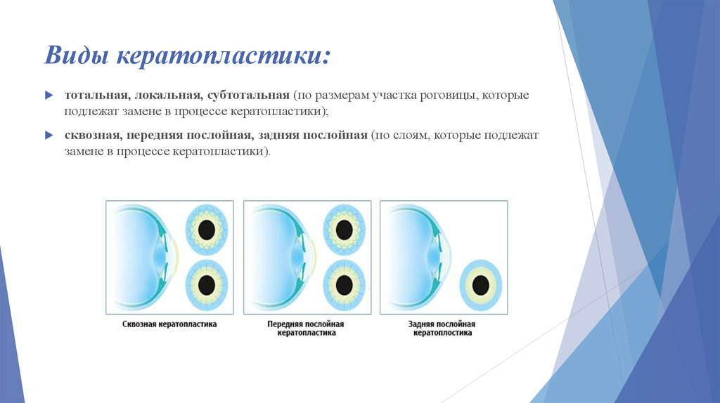 Это метод послойной визуализации обеспечивающий изображение слоя тканей заданной толщины