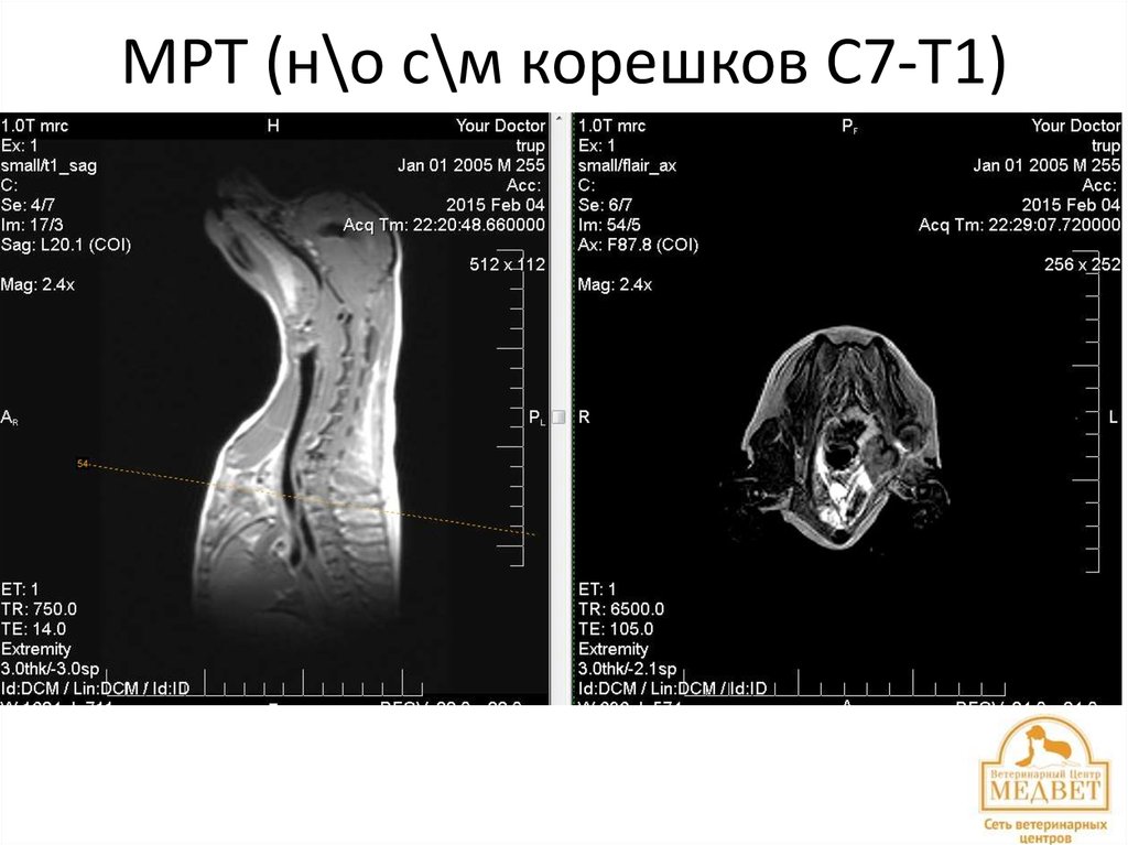 МРТ (н\о с\м корешков С7-Т1)
