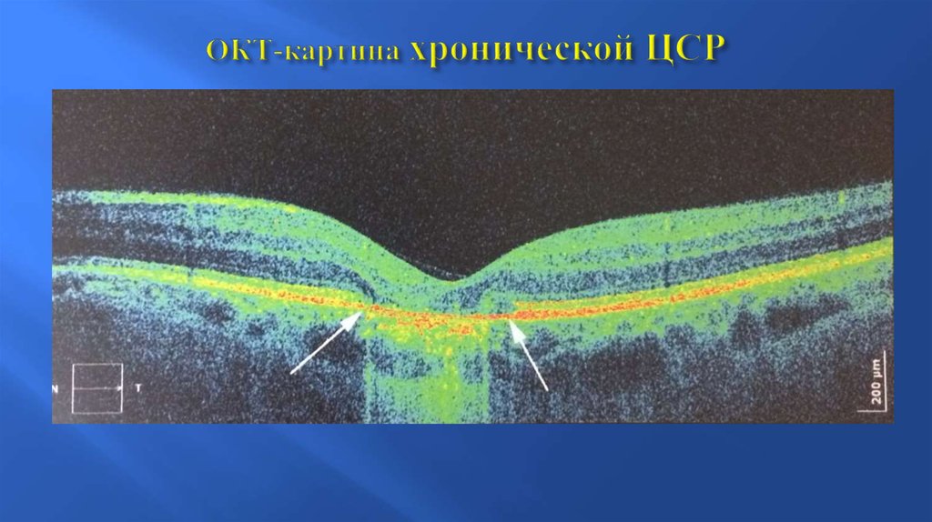 Окт. Оптическая когерентная томография в стоматологии. Окт картина. Оптическая когерентная томография при увеите. Окт картина хориоретинита.