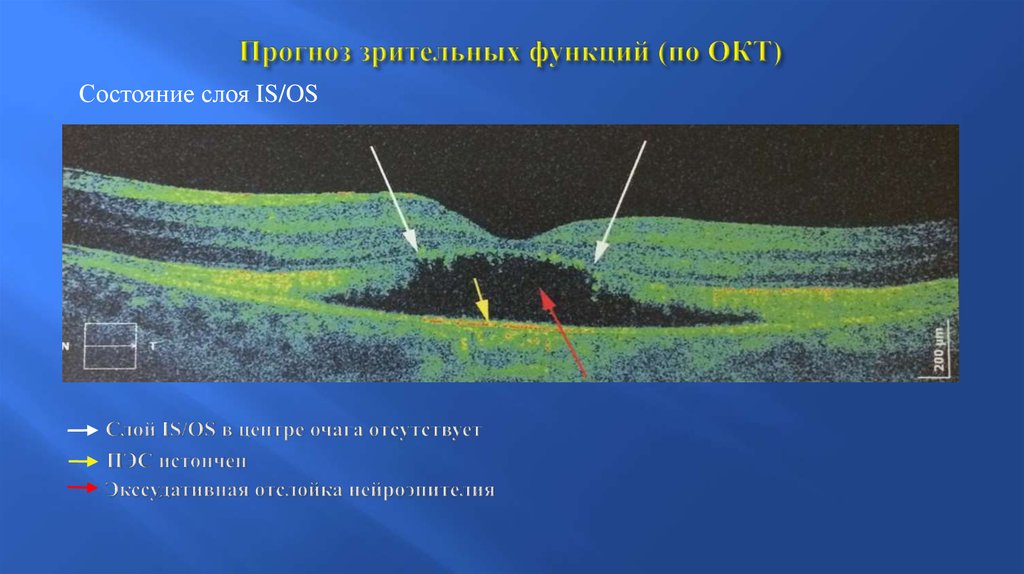 Окт. Слои сетчатки по окт. Оптическая когерентная томография слои сетчатки. Слои сетчатки глаза на окт. Окт норма.