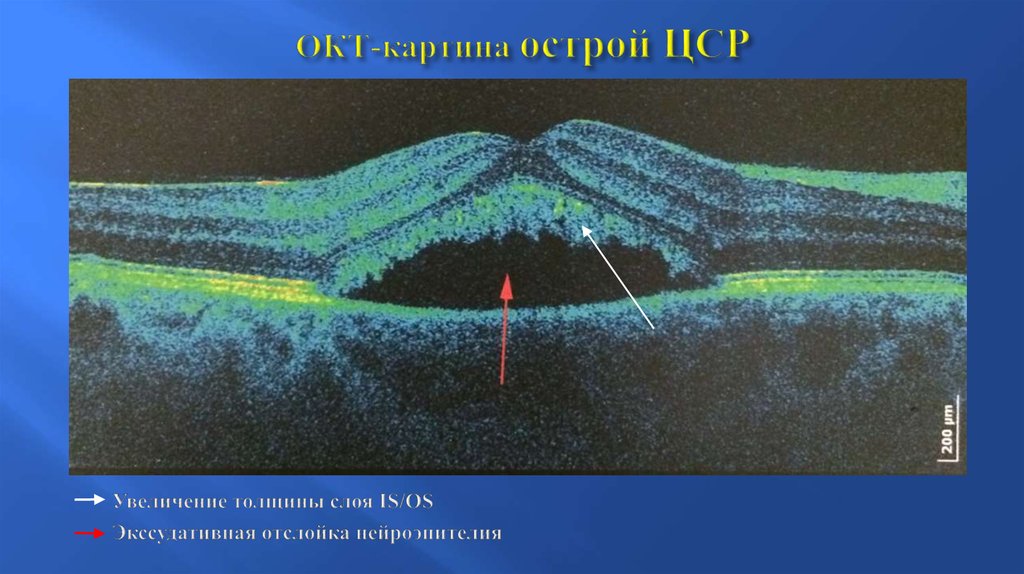 Оптическая томография. Отслойка нейроэпителия на окт. Окт картина. Центральная серозная хориоретинопатия ОСТ. Центральной серозной хориопатии окт.