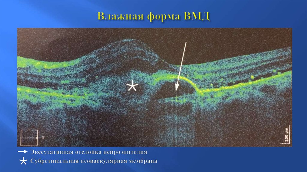 Когерентная картина. Возрастная макулодистрофия окт. ВМД влажная форма классификация.