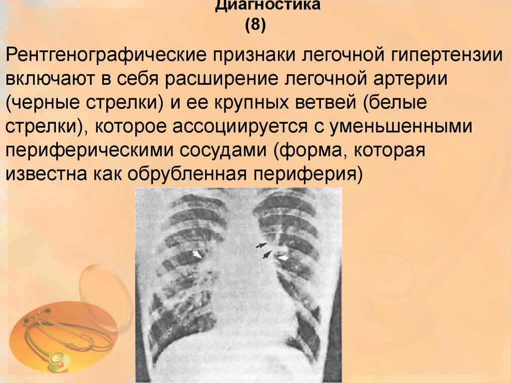 Легочная артериальная гипертензия презентация