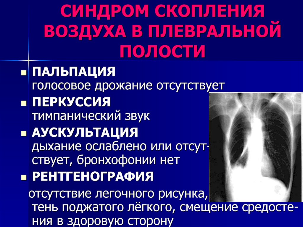 Полость проявление. Синдром скопления воздуха в плевральной полости. Синдром скопления воздуха в полости плевры. Воздух в плевральной полости. Синдром скопления жидкости и воздуха в плевральной полости.