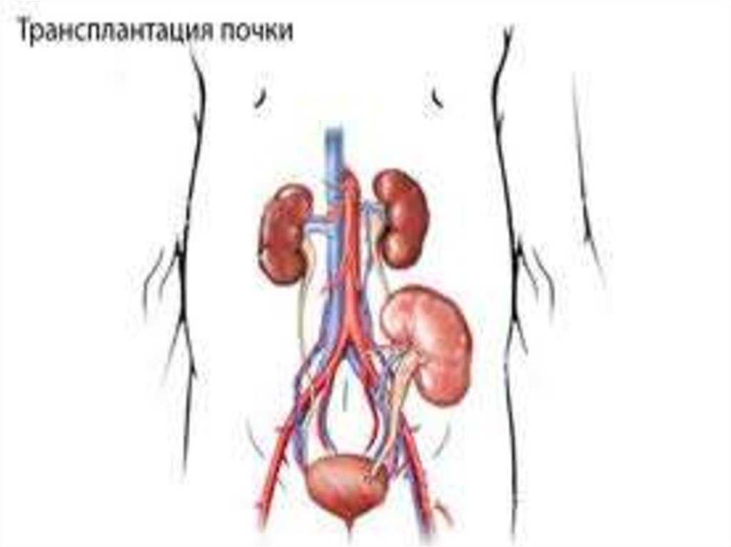 Трансплантация почки отзывы