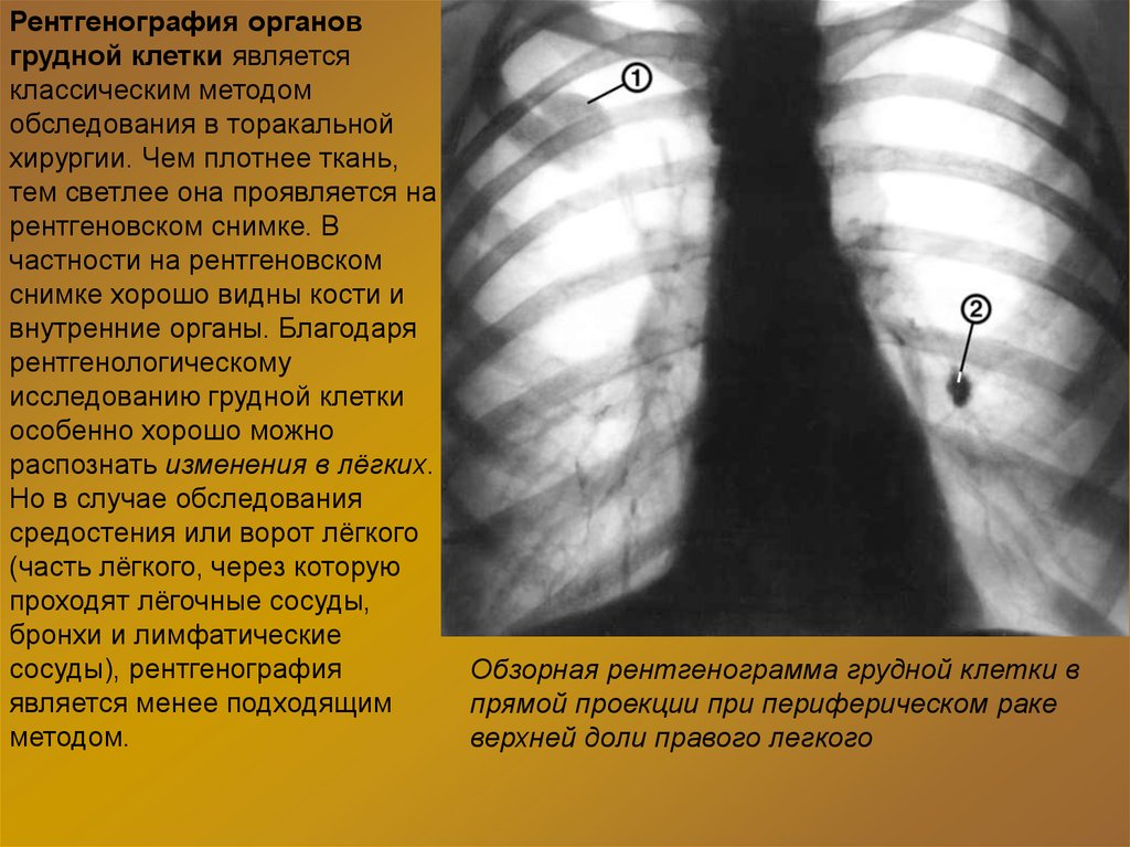 Затемнение верхней доли легкого. Рентгенограмма грудной клетки. Болезни легких на рентгене. Рентген органов грудной клетки в прямой проекции. Изменения на рентгенографии грудной клетки.