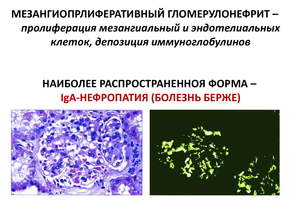 Морфологическая картина гломерулонефрита