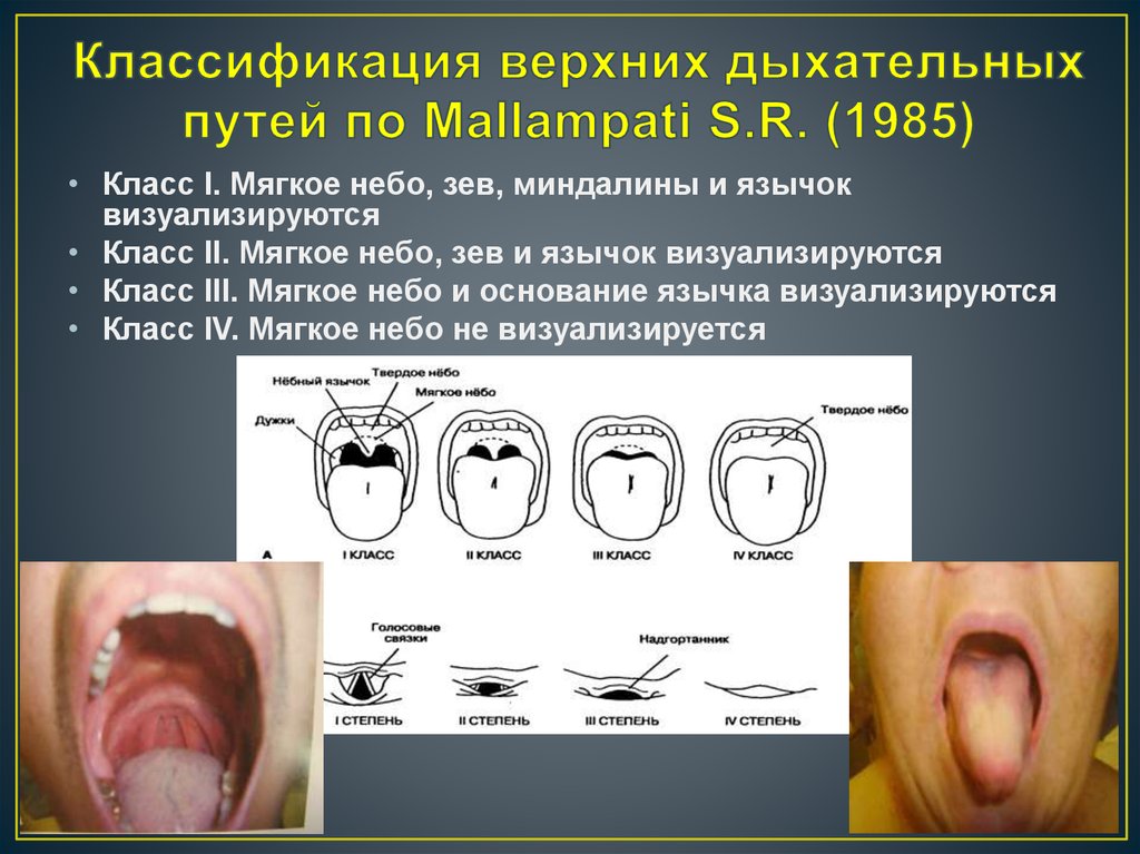 Классификация верхних дыхательных путей по Mallampati S.R. (1985)