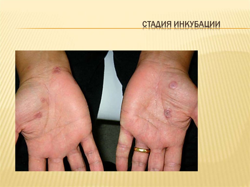 Стадия инкубации