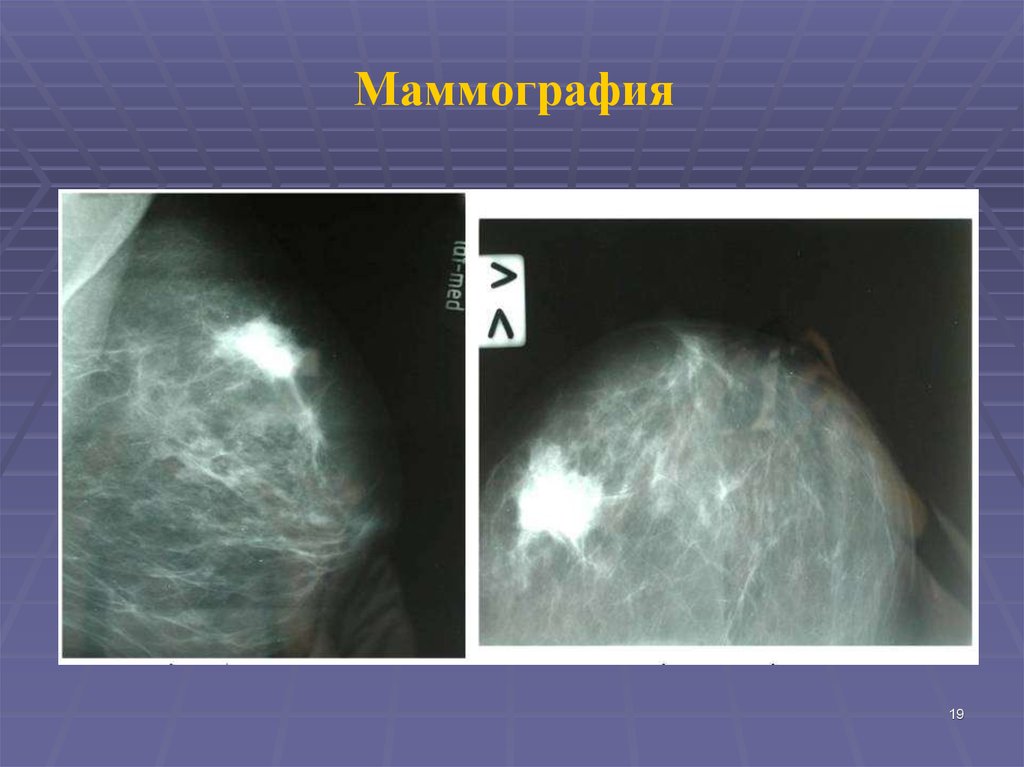 Маммография старый. Мелкоузелковый аденоз. Фиброаденома молочной железы маммография.
