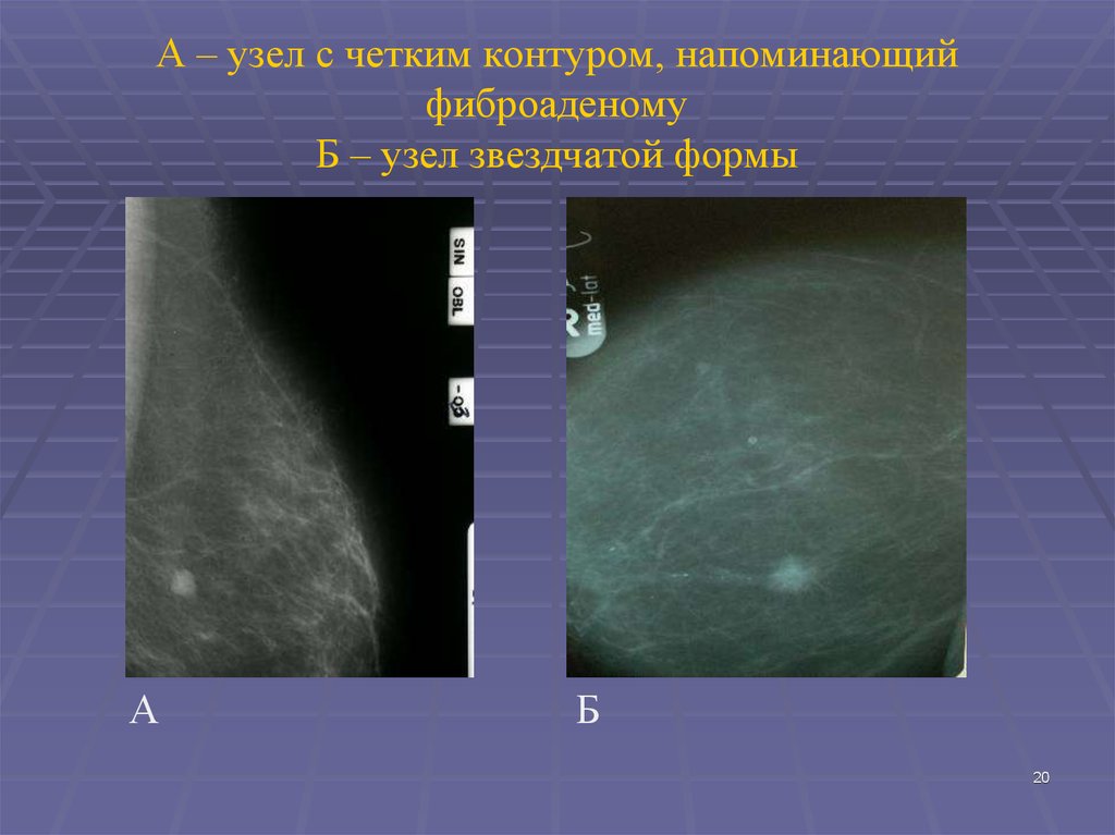 Форма фиброаденомы. Листовидная форма фиброаденомы. Четкие контуры фиброаденомы.