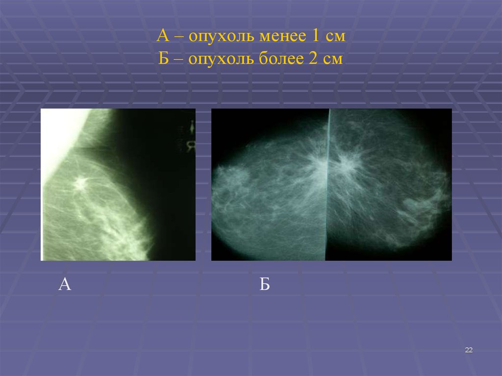 А – опухоль менее 1 см Б – опухоль более 2 см