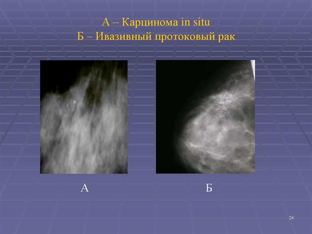 Протоковая карцинома in situ молочной