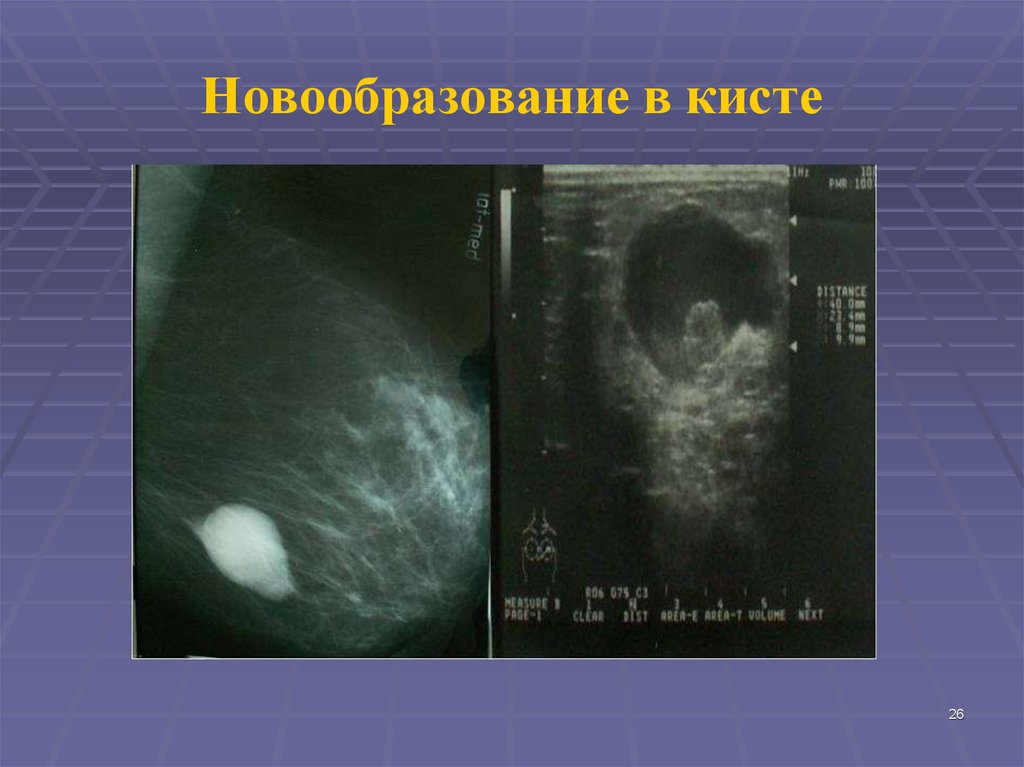 Новообразование в кисте