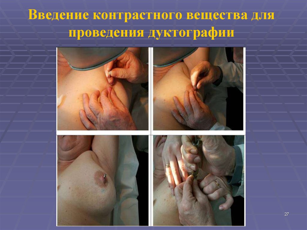 Введение контрастного вещества для проведения дуктографии