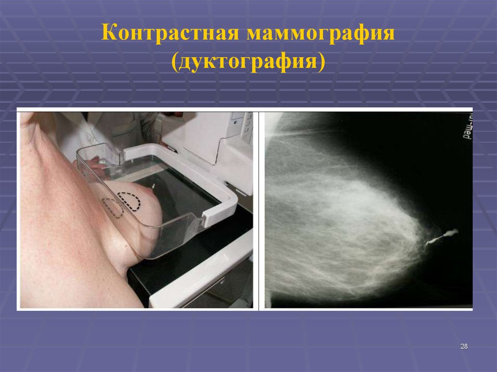 контрастная маммография молочных