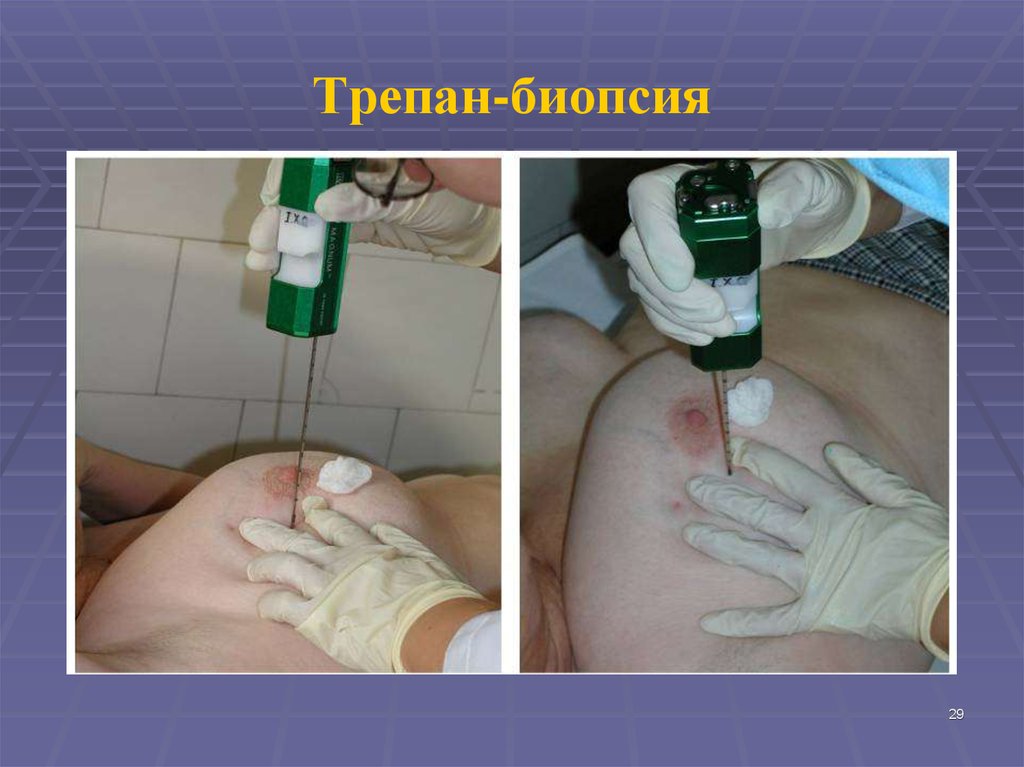 Трепан-биопсия